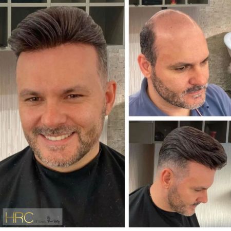 Embrace Confidence: The Importance of Men's Hair Replacement with HRC of Iowa