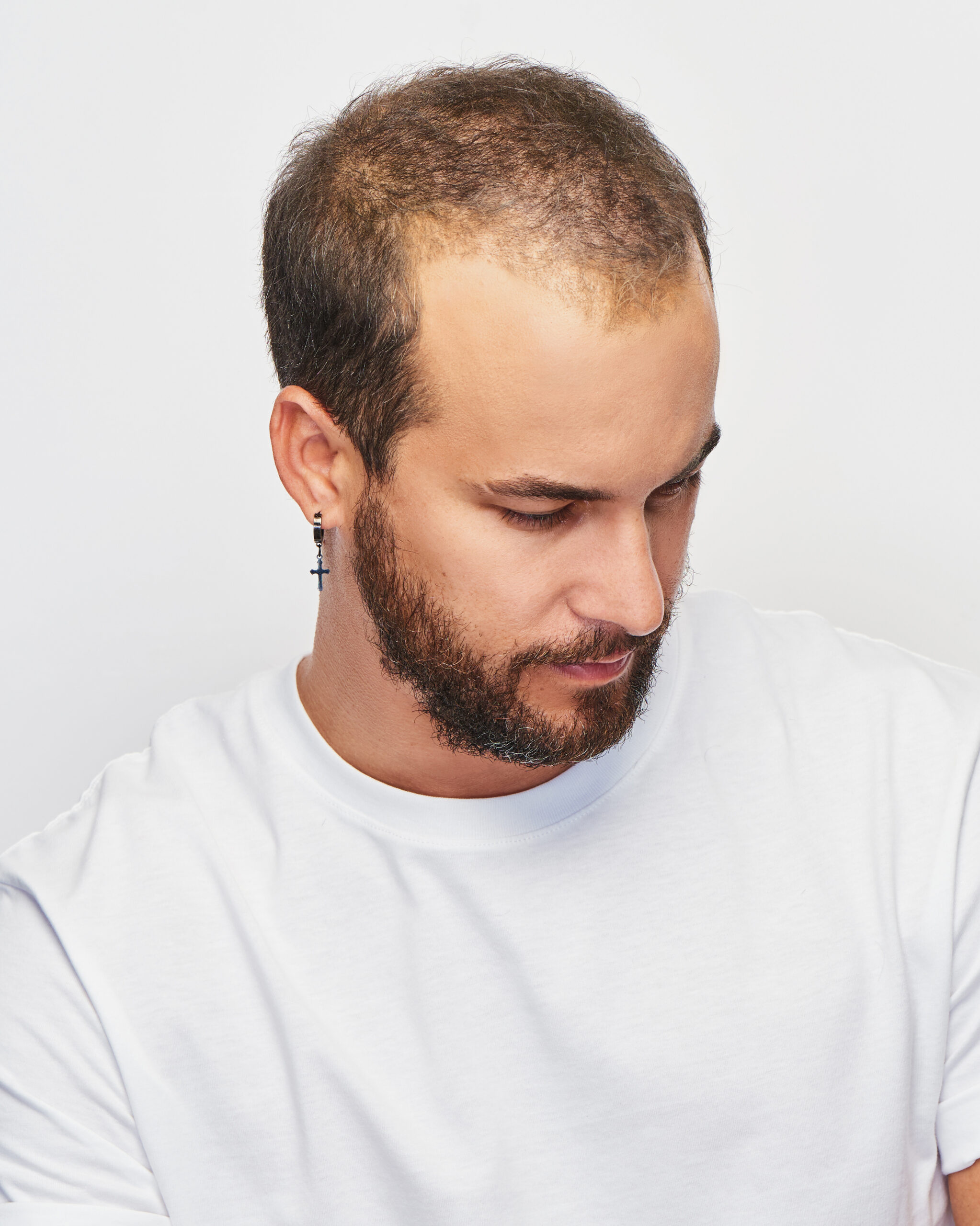 Male pattern hair loss