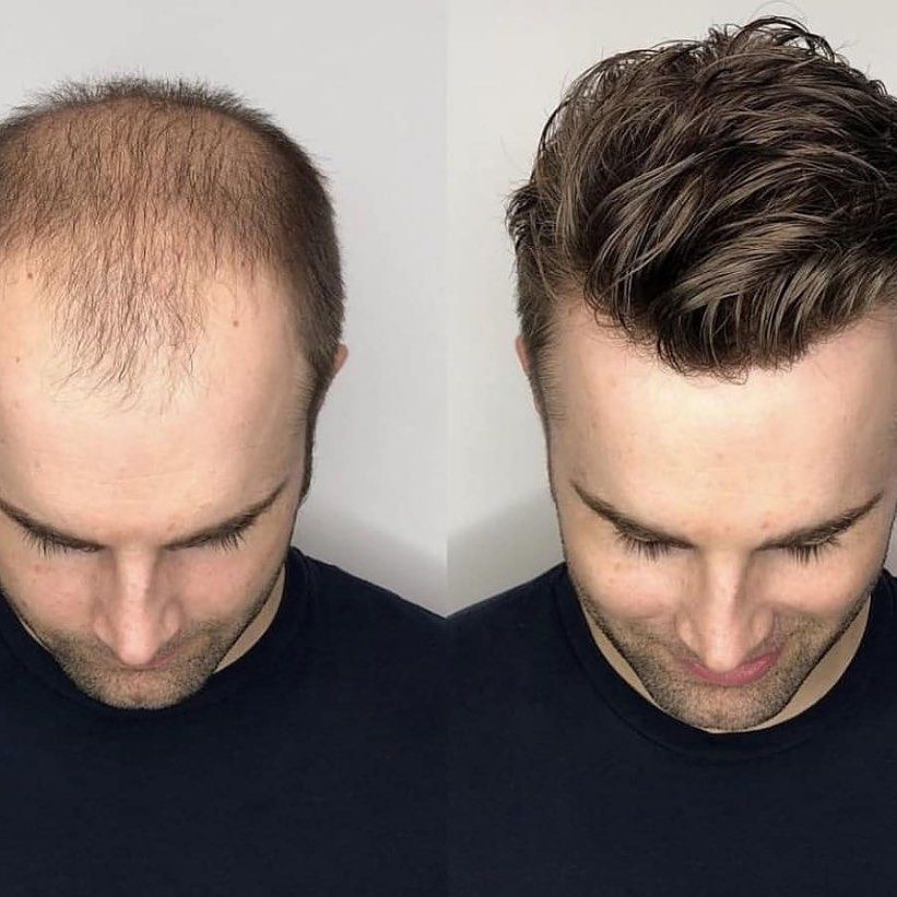 Men’s Hair Replacement Before and After