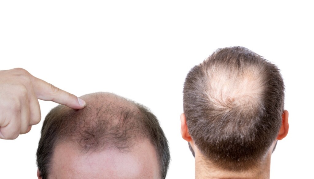 Male Hair Loss