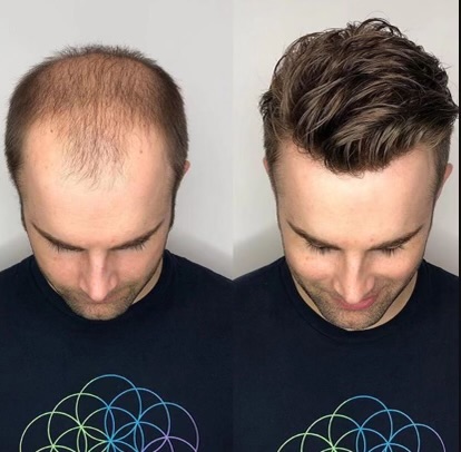 Before and after of a man with hair loss