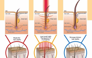 Cold Laser Light Hair Growth Therapy