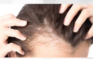 Concealing Hair Loss