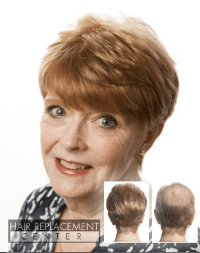 Hair Replacement Center - HRC of Iowa