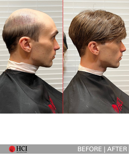 HCI Hair Solutions Before and After Gallery