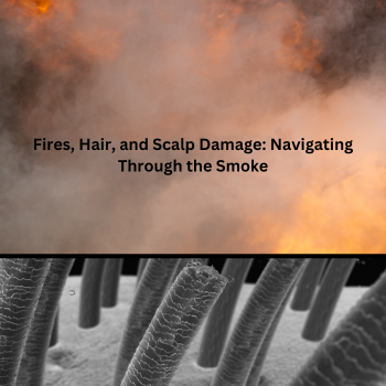 Fires, Hair, and Scalp Damage: Navigating Through the Smoke