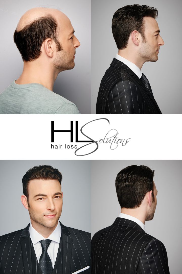 Hair Loss Solutions Gallery