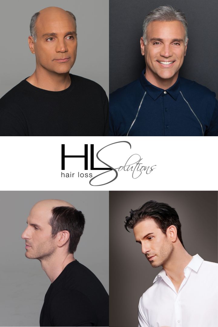 Hair Loss Solutions Gallery