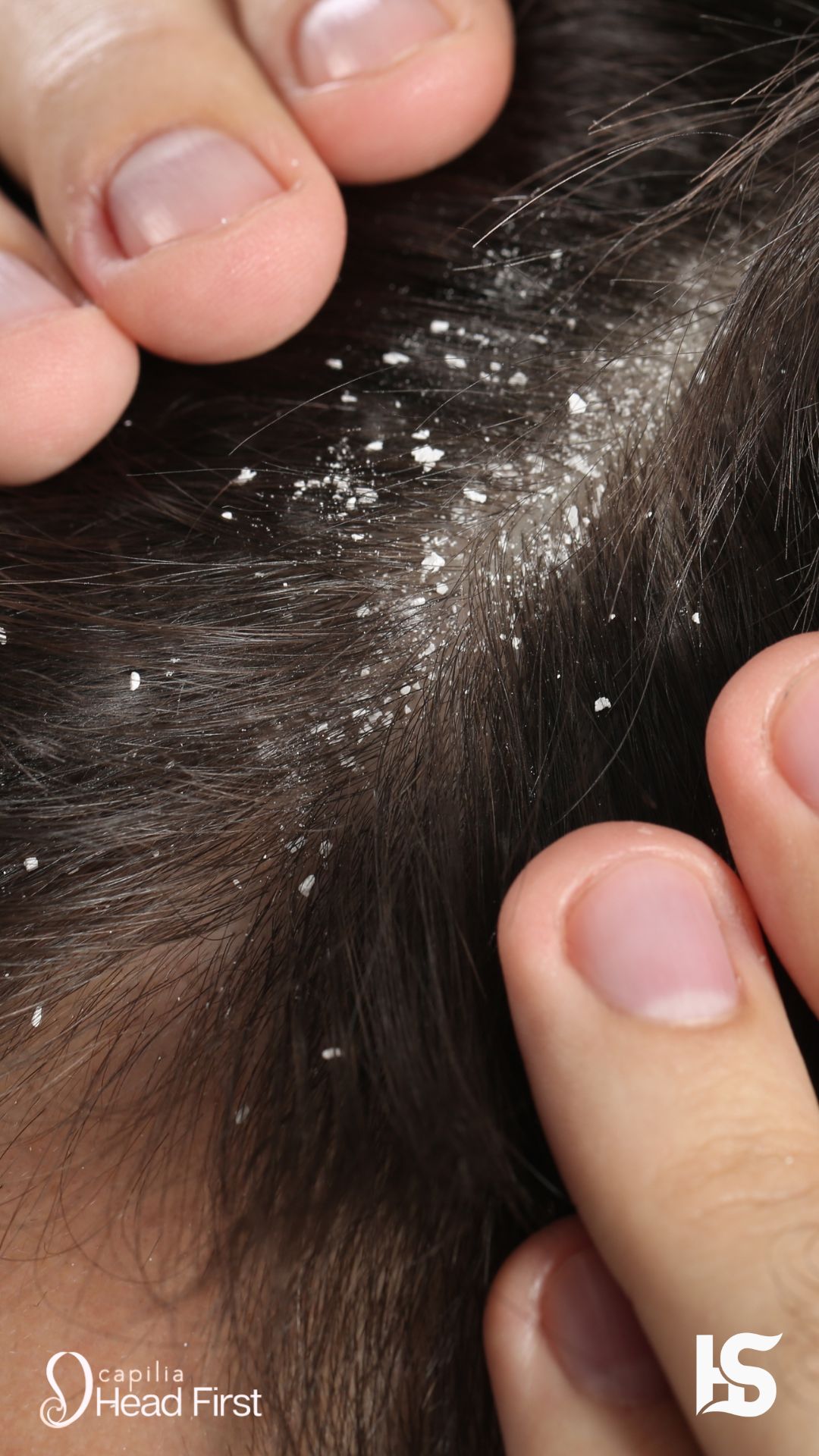 Dandruff Capilia - Dandruff
