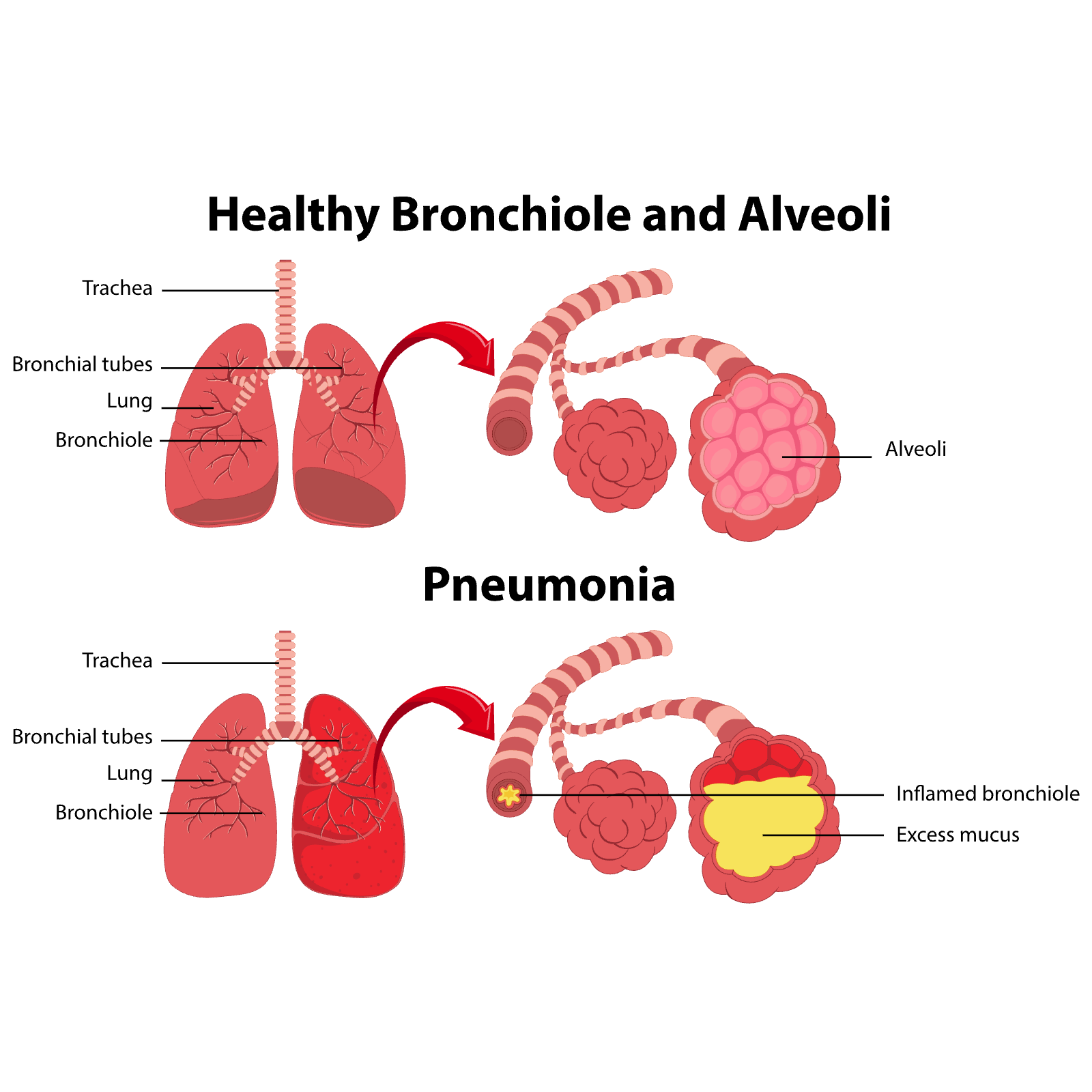 Healthy vs. Pneumonia-Affected Lungs