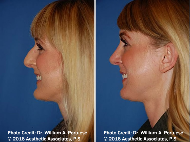 the best nose job surgeon