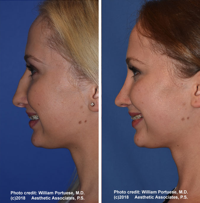 best rhinoplasty surgeon in washington