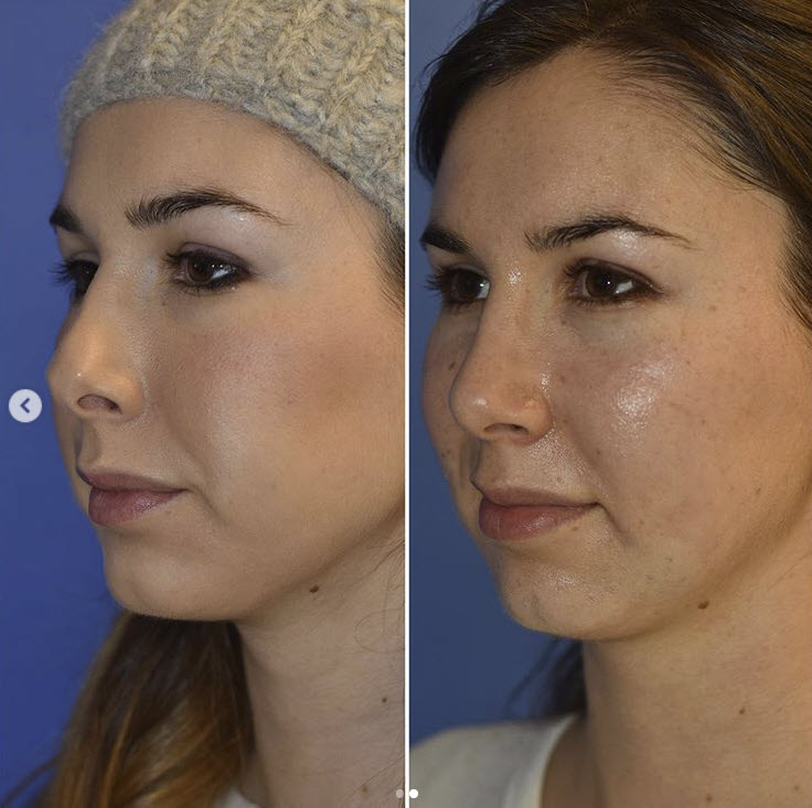 top rhinoplasty seattle