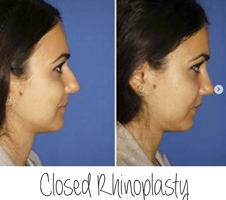 rhinoplasty seattle wa