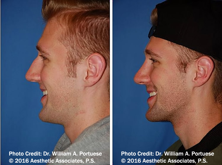 rhinoplasty seattle wa