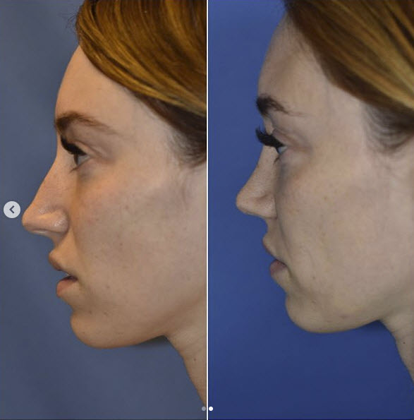 rhinoplasty specialist