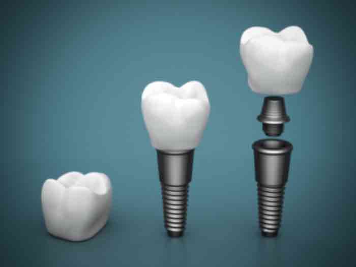 Seniors: How Dental Implants Can Bring Back Your Smile