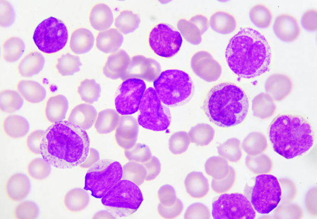 The Warning Signs of Leukemia