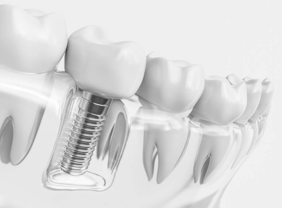 How Dental Implants Give Seniors a Healthy Smile