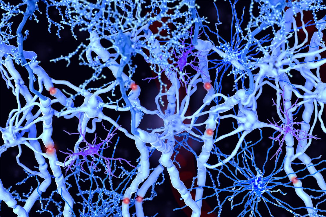 Early Signs of Multiple Sclerosis