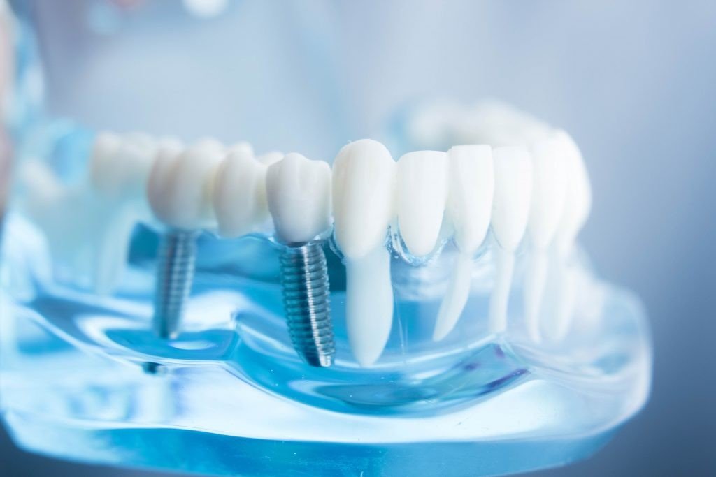 The Importance of Dental Implants for Seniors