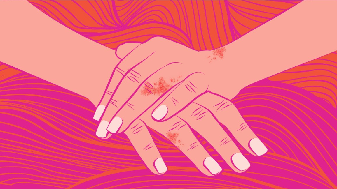 Psoriatic Arthritis: What You Need to Know