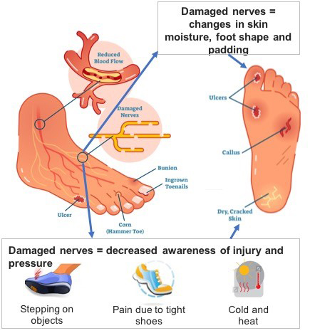 diabetic foot diagram