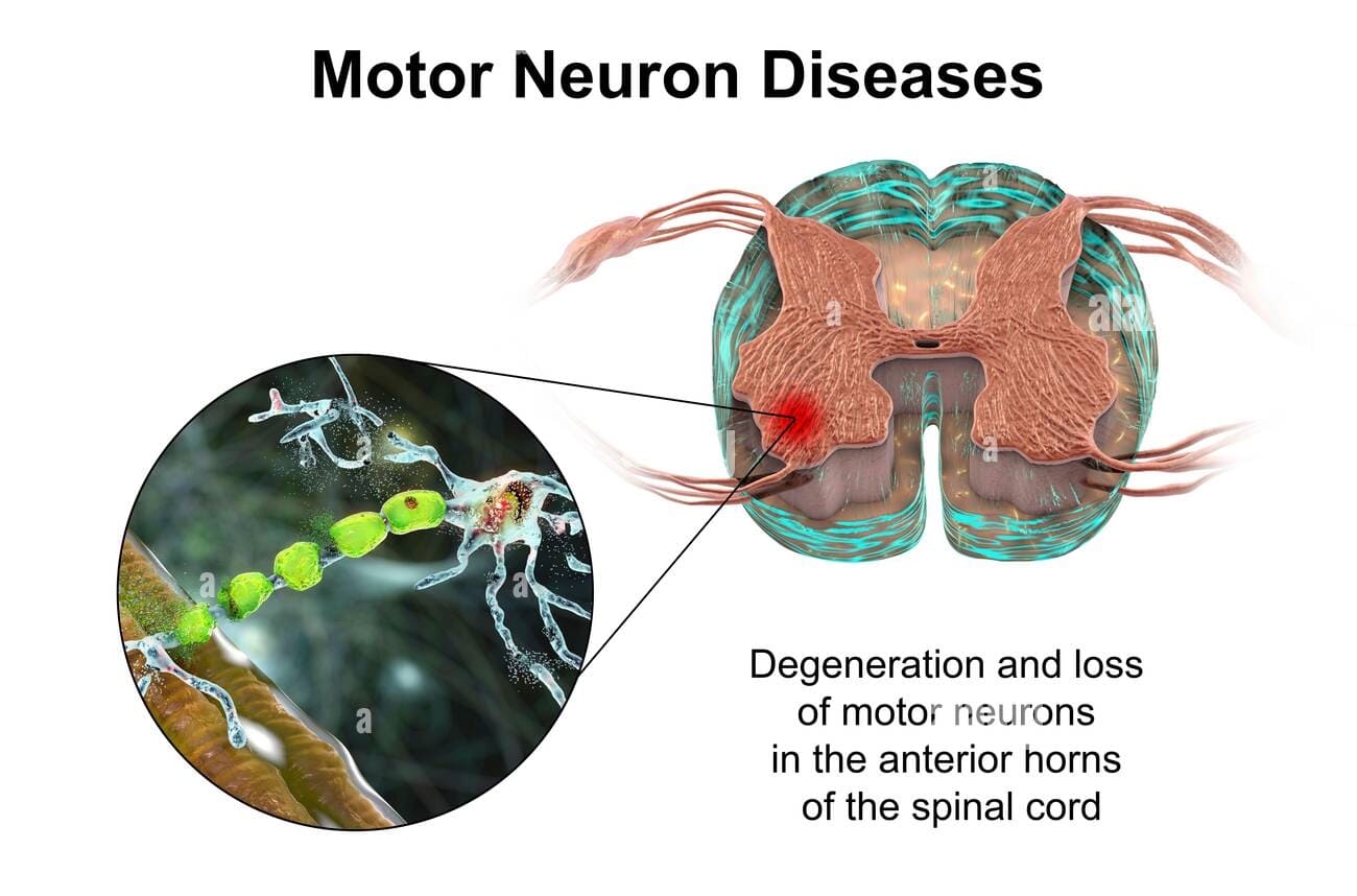 Motor Neuron Disease