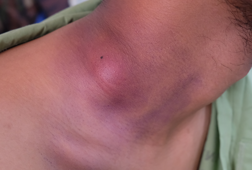 ต่อมน้ำเหลืองอักเสบ เกิดจากอะไร อันตรายไหม