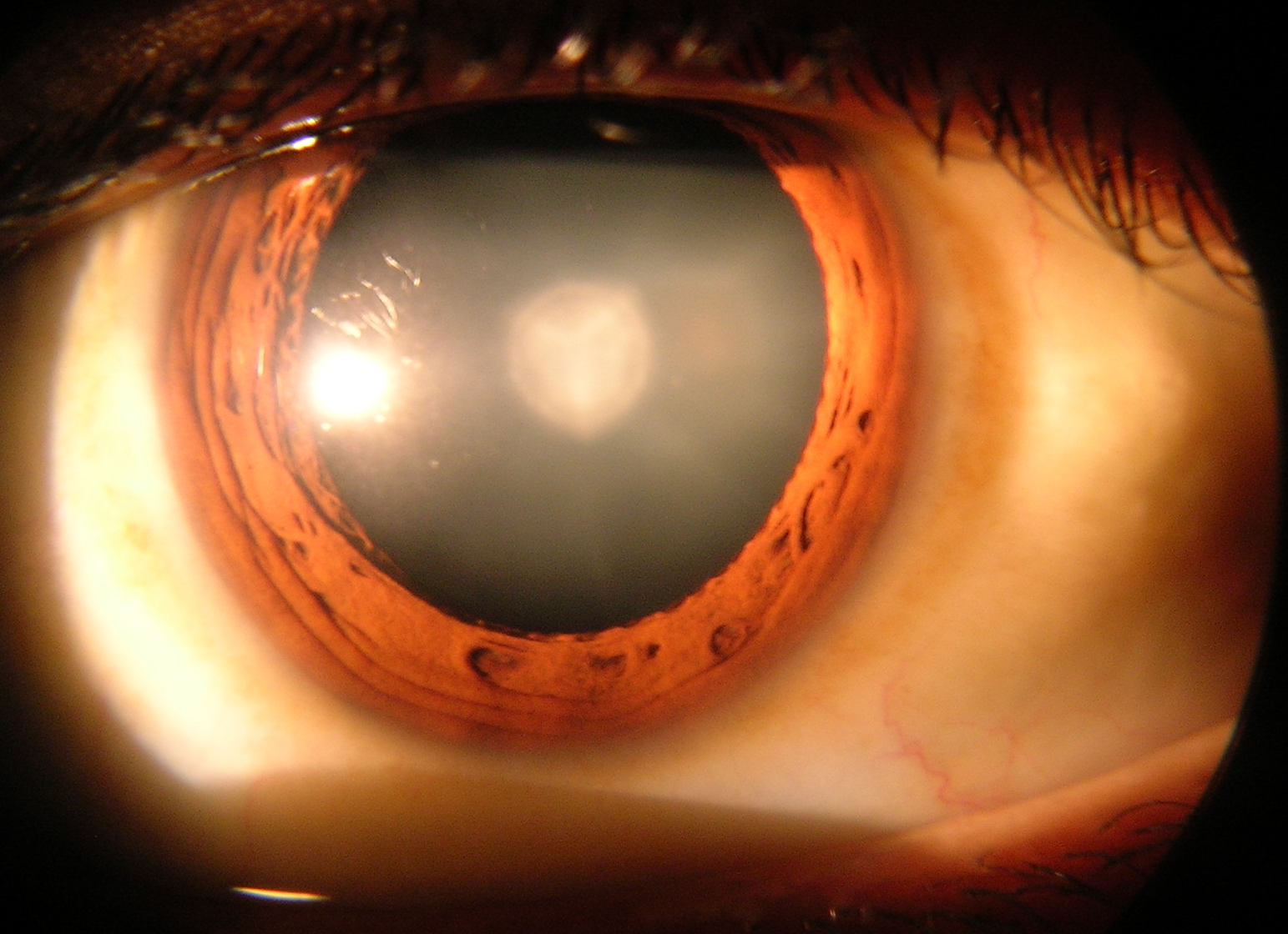 Cataract_in_human_eye.png