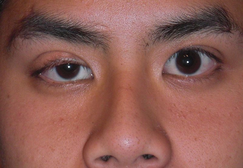 Congenital_ptosis.JPG