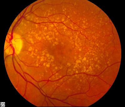 Intermediate_age_related_macular_degeneration.jpg