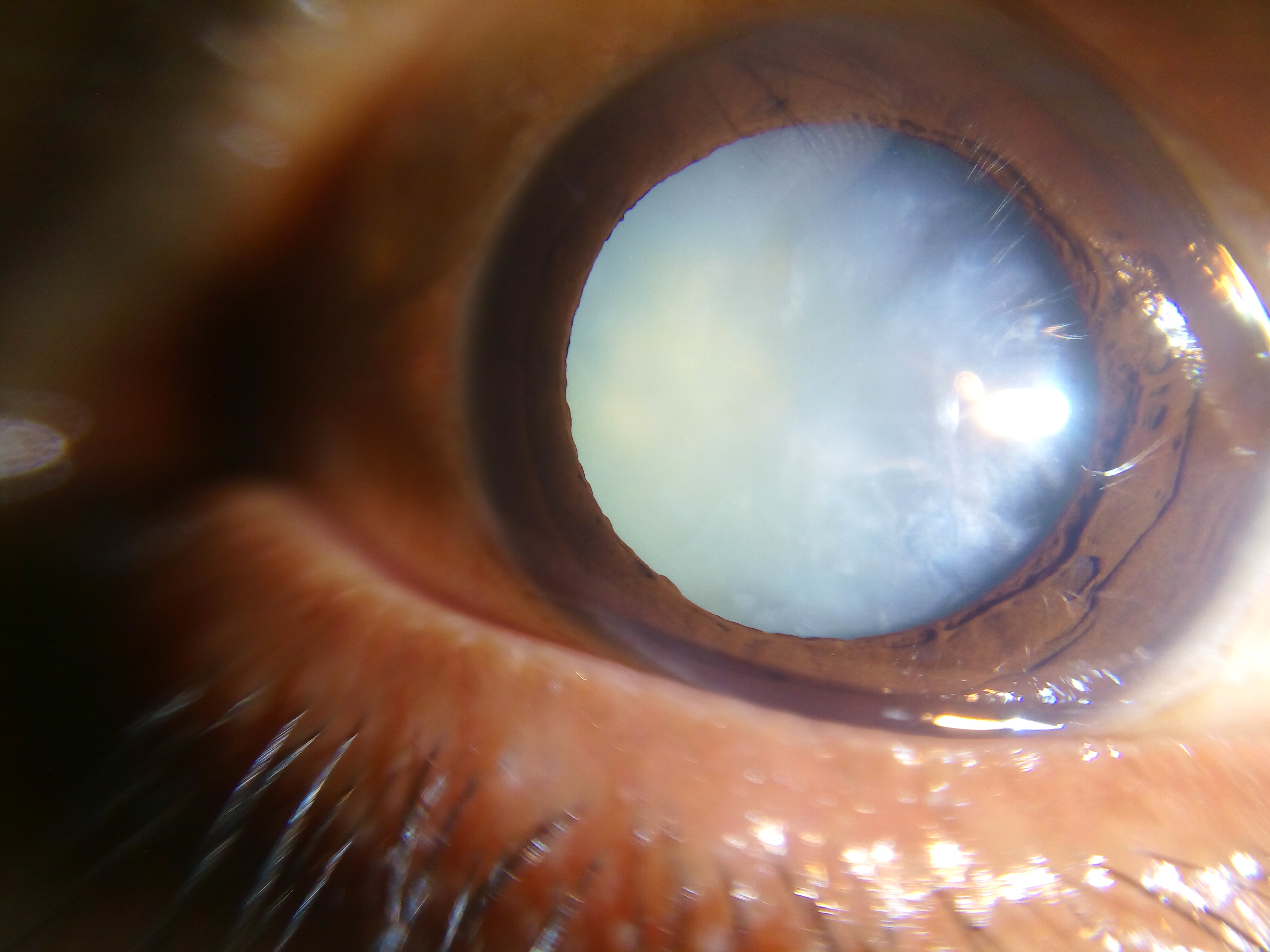 cataract surgery detached retina symptoms