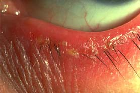 blepharitis1.jpg