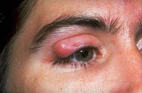 blepharitis2.jpg