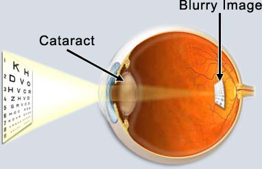 cataracts1.jpg