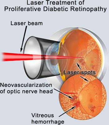 diabetic retinopathy treatment