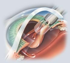 lensectomy.jpg