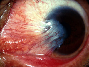 pterygium.jpg