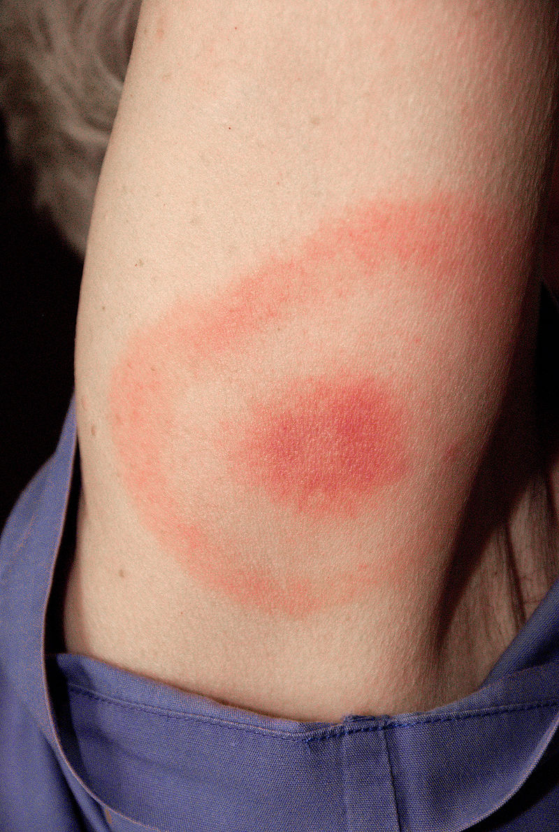 800px-Erythema_migrans_-_erythematous_rash_in_Lyme_disease_-_PHIL_9875.jpg