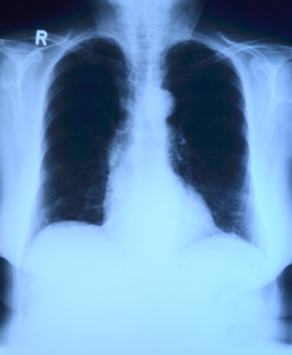 A pair of healthy lungs is critical for good health.