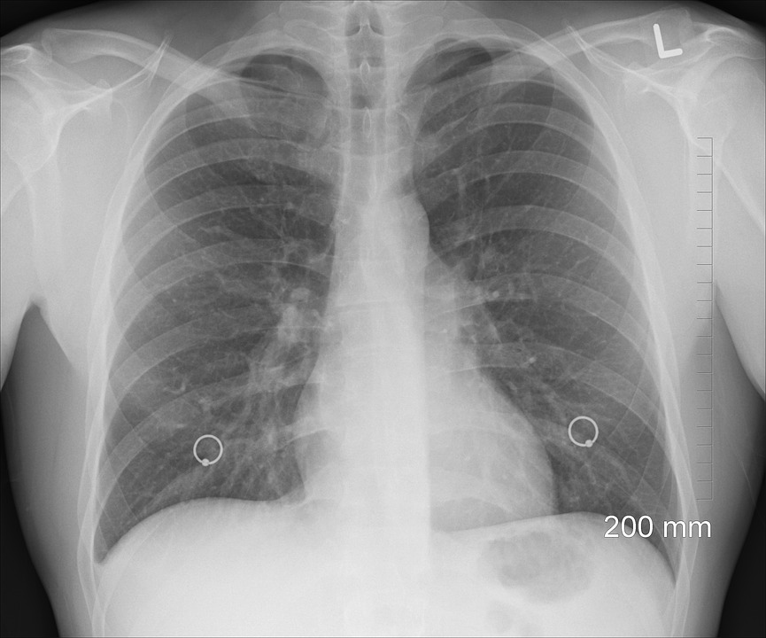 Healthy lungs are a critical part of a healthy life.