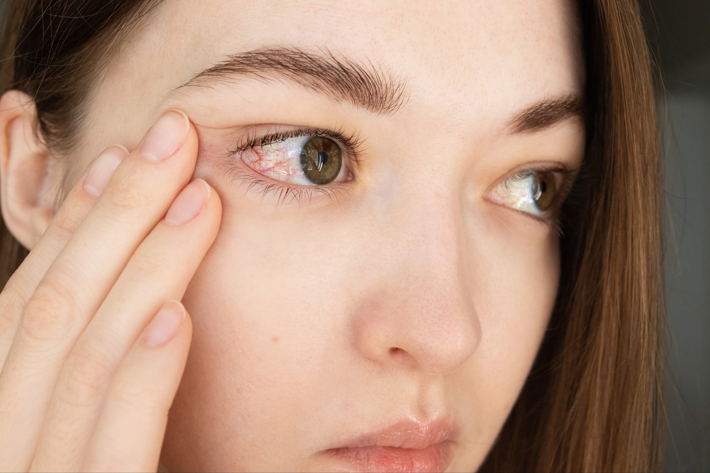 woman suffering from eye redness and irritation