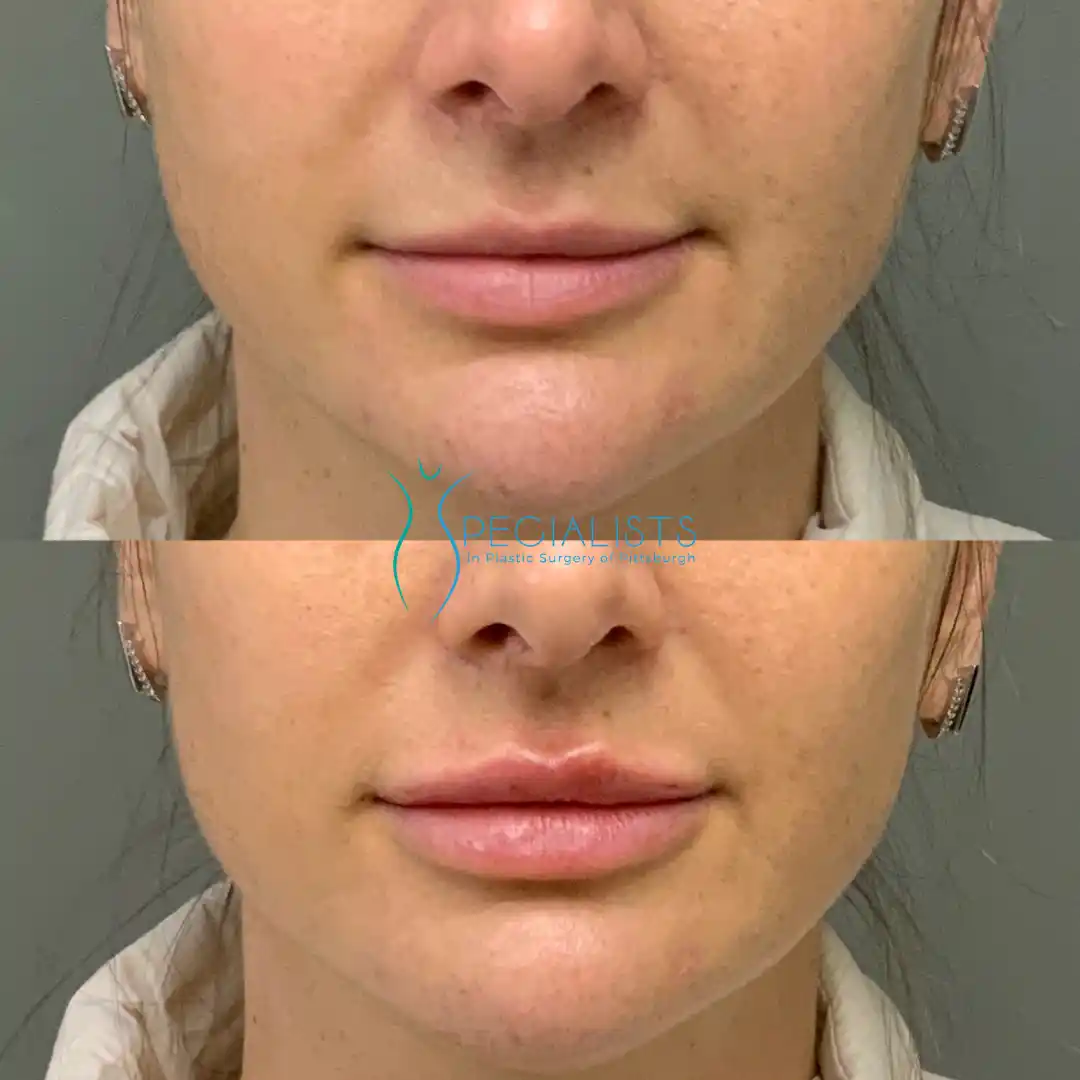 Fillers and Injectables 10