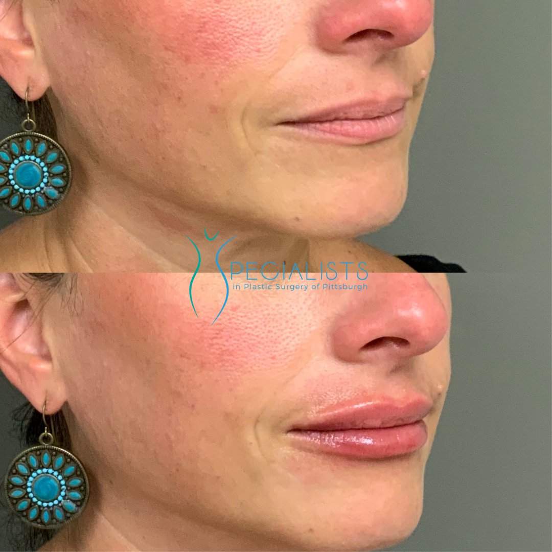 Fillers and Injectables - Before and After - 6