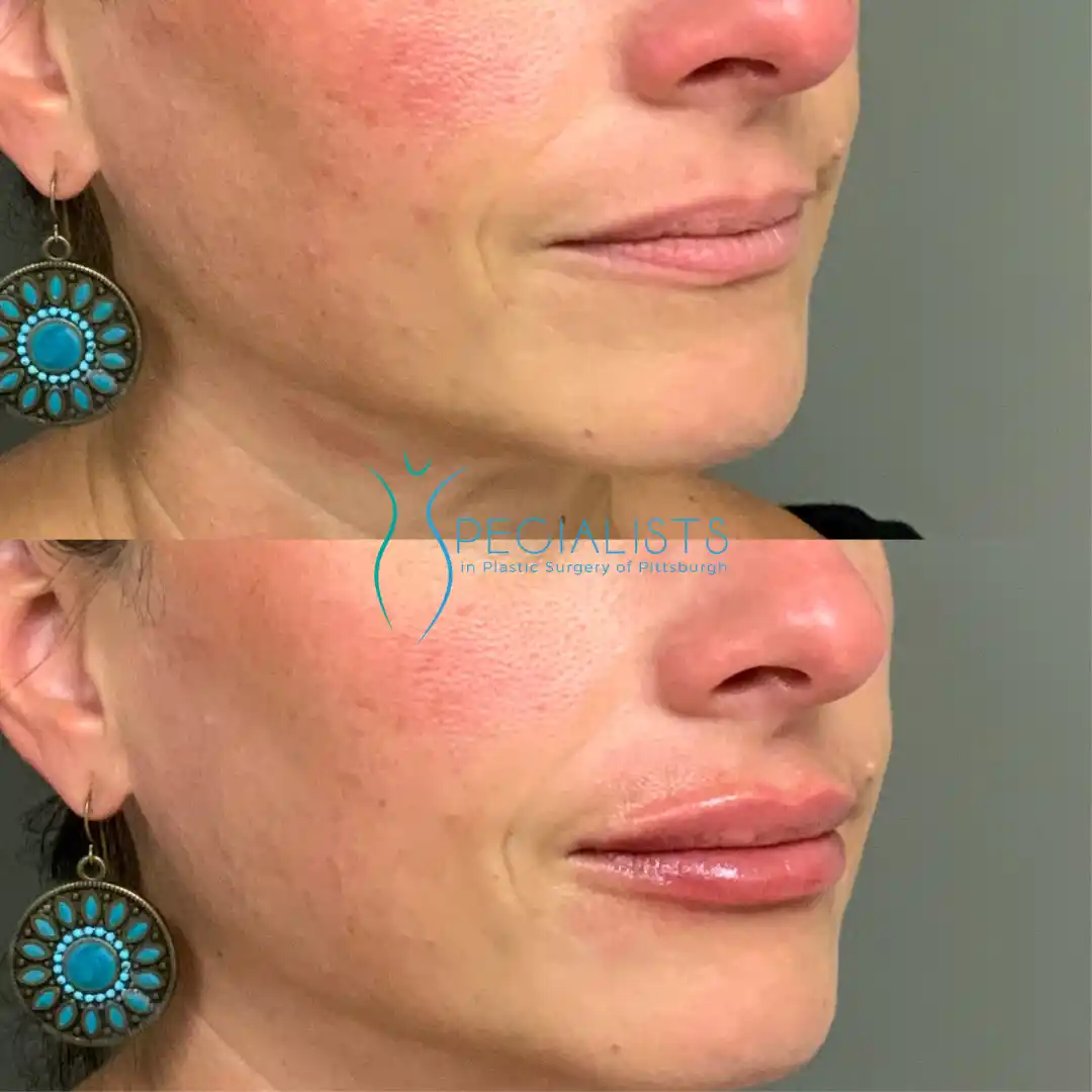 Fillers and Injectables 6