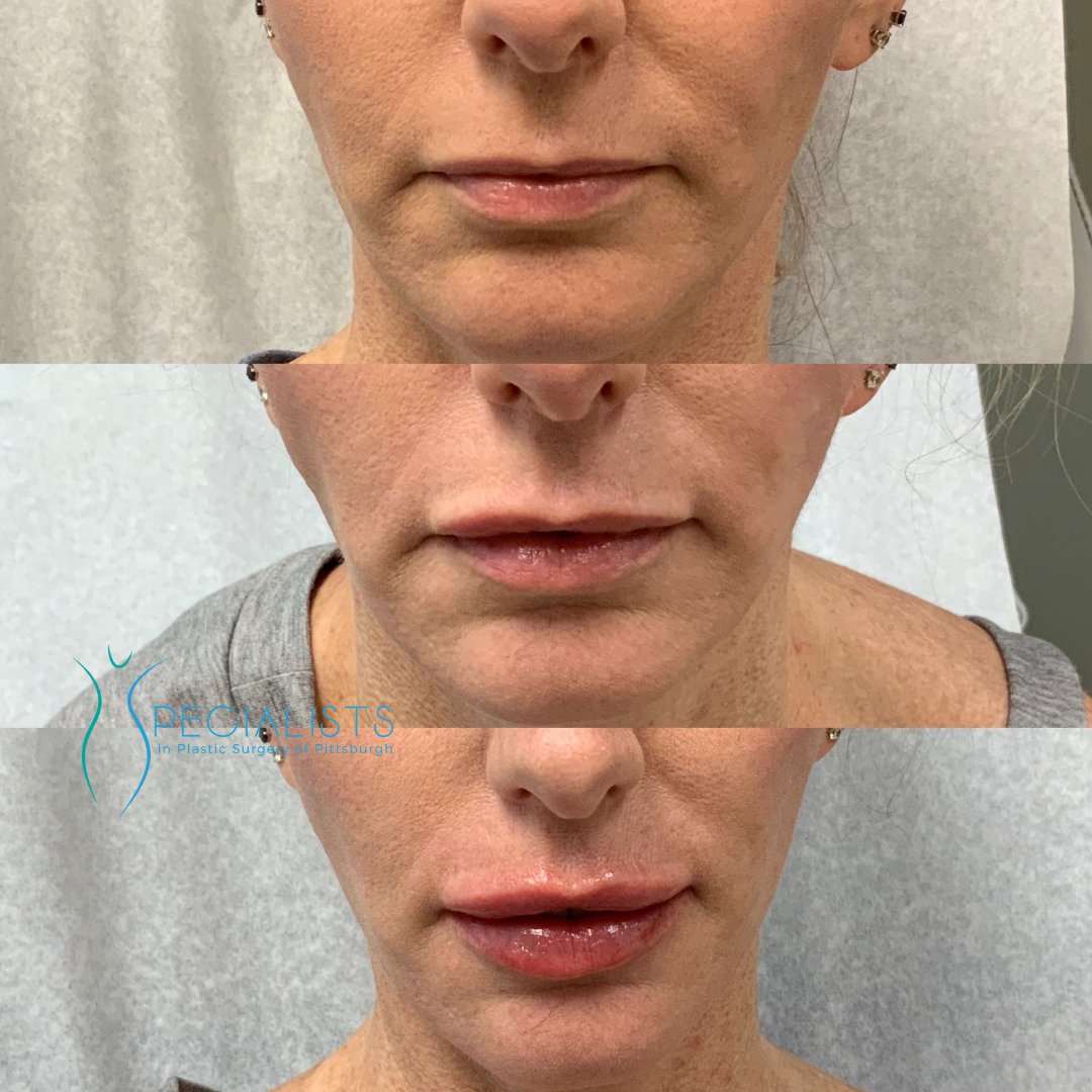 Fillers and Injectables - Before and After - 7