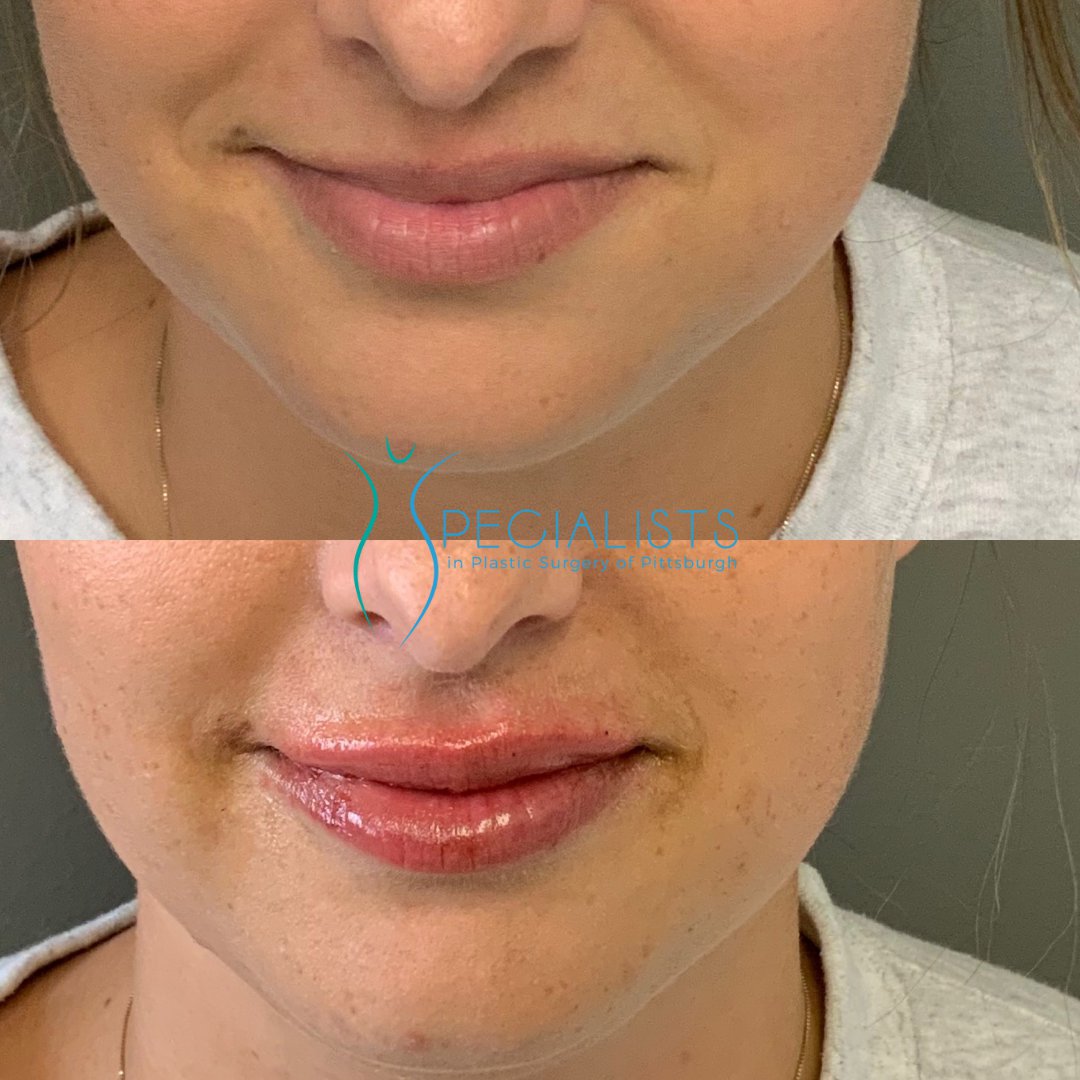 Fillers and Injectables - Before and After - 5