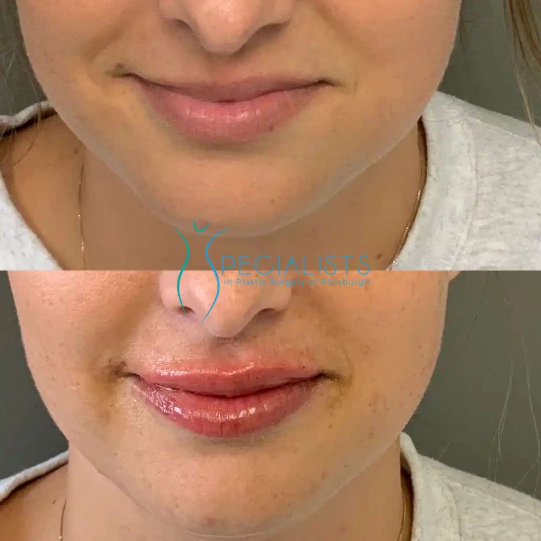 Fillers and Injectables 5