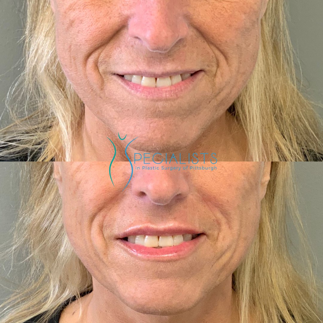 Fillers and Injectable before-after2